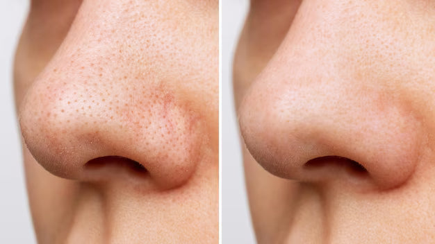 DermaClean Pro™: Limpieza facial profunda tipo spa en casa
